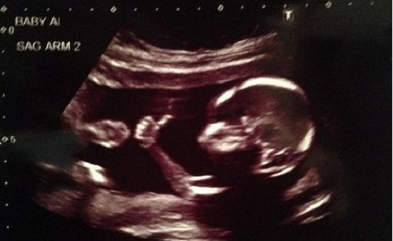Appeals Court Upholds Kentucky Law Letting Women See Ultrasound of Their Baby Before Abortion