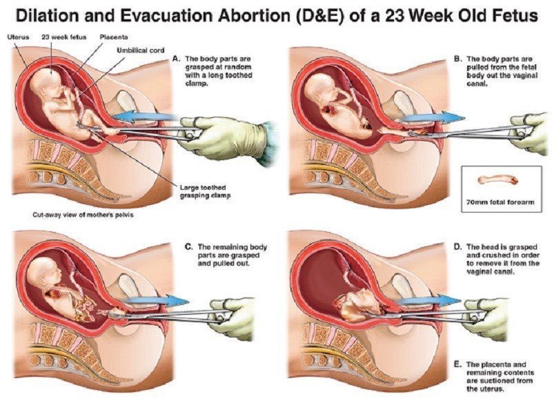 Judge Upholds Oklahoma Law Banning Dismemberment Abortions That Tear Off Babies’ Limbs