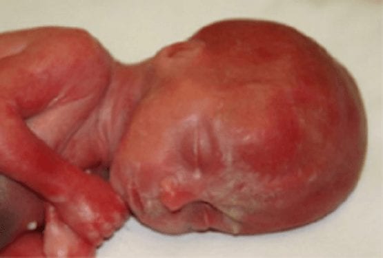 Three Babies in Minnesota Were Born Alive After Failed Abortions in 2018 and Left to Die