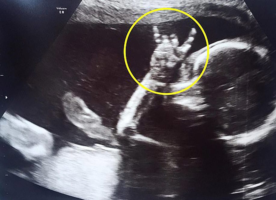 Awesome Ultrasound Photo Shows Unborn Baby Flashing Rock and Roll Sign