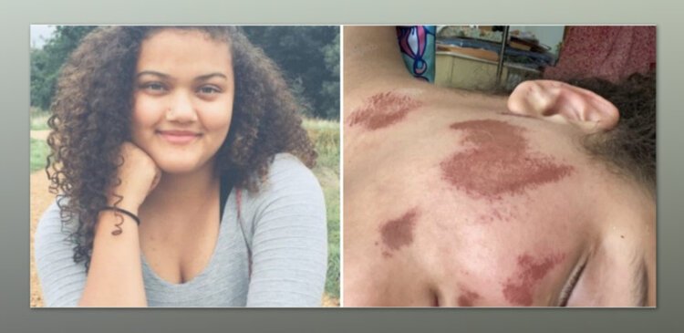 Half Black, Half Jewish Young Woman Set on Fire, Called Racial Slur in Horrific Hate Attack